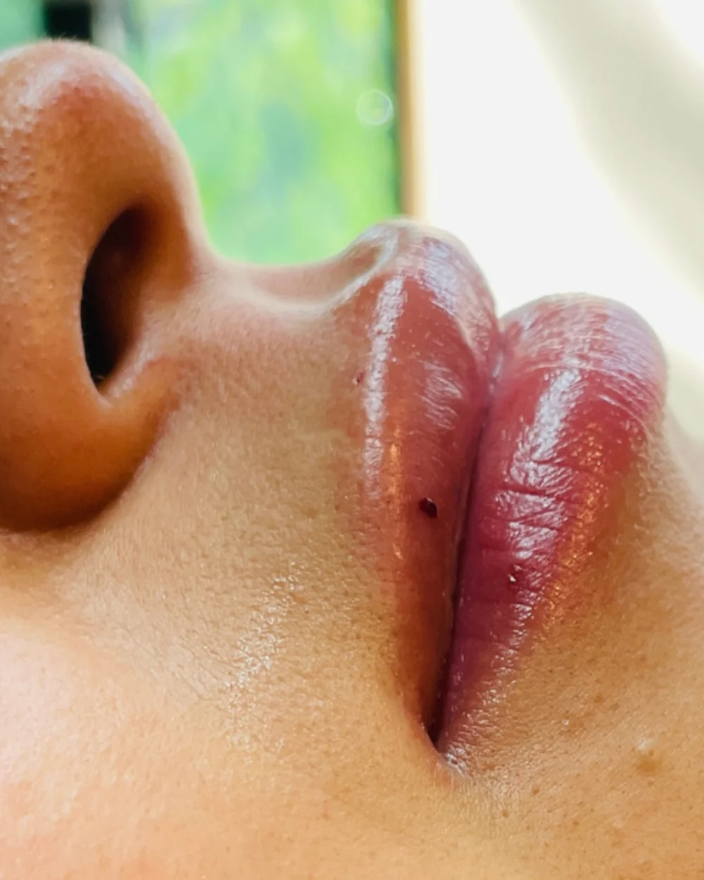 Después: relleno de labios con ácido hialurónico
